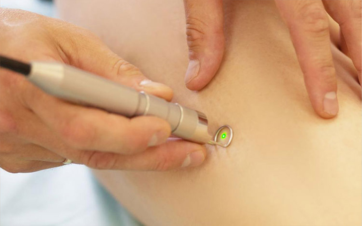 Lazerle Varis Tedavisi