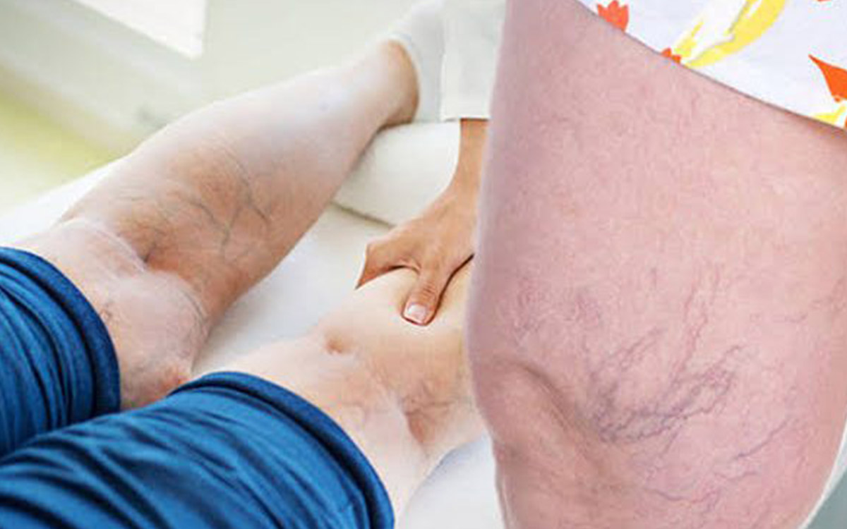 What are the Types of Varicose Veins?