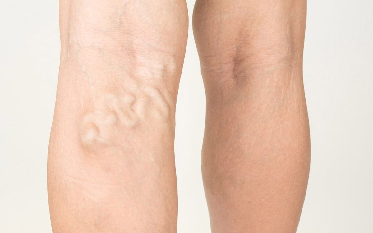 What is Varicose Vein?