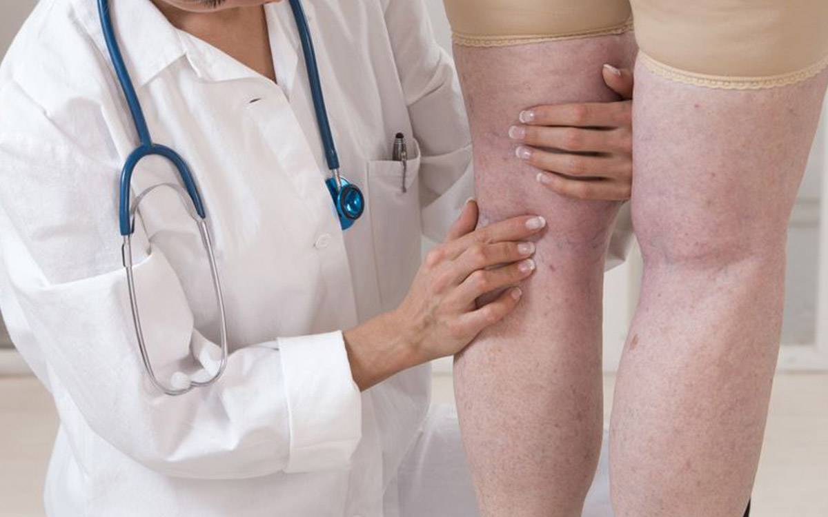 Varicose Vein Treatment