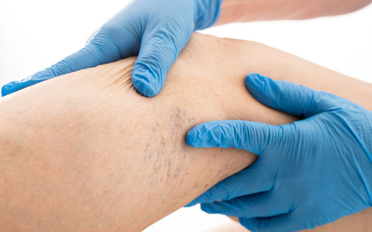 How is Varicose Vein Diagnosed?