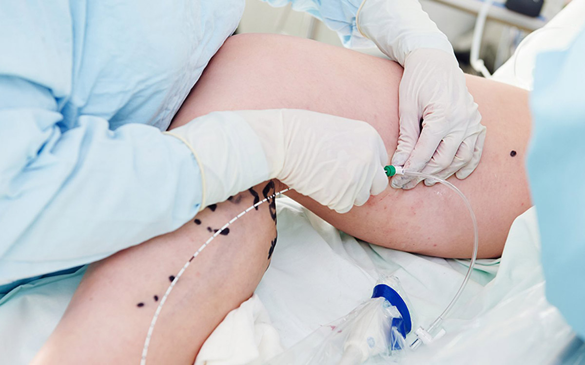 Medical Adhesive (Glue) Method for Varicose Veins