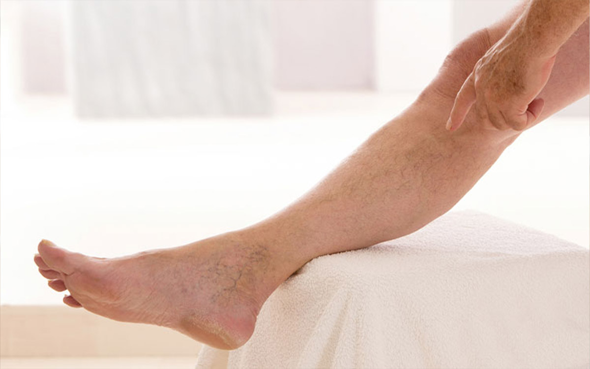 Deep Vein Thrombosis Symptoms