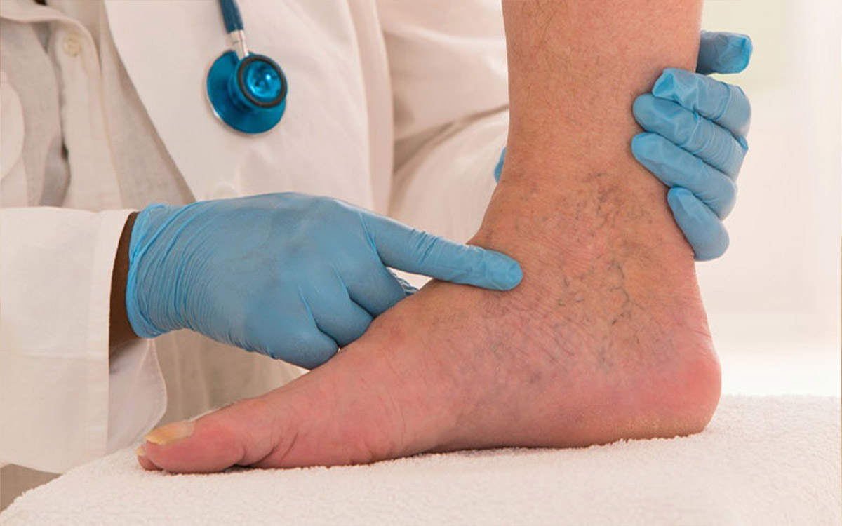 What is Deep Vein Thrombosis?