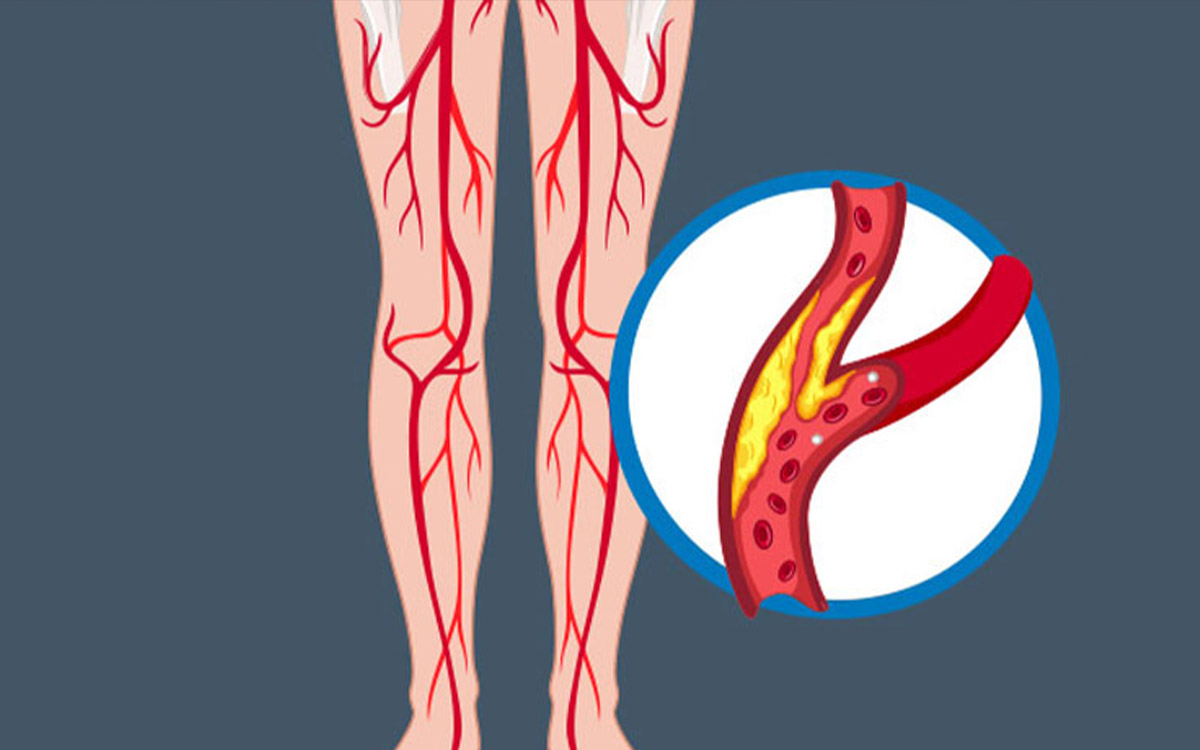 What is the Peripheral Artery Disease?