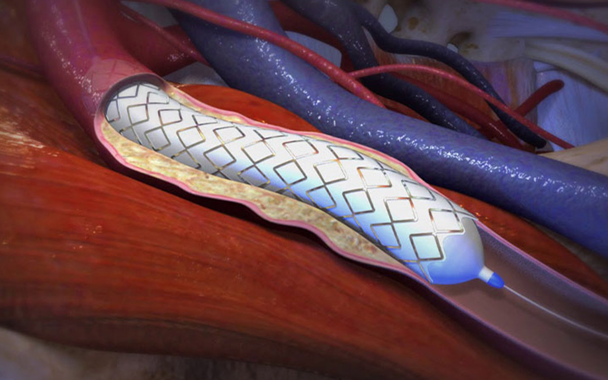 Endovascular Treatment in Peripheral Artery Diseases