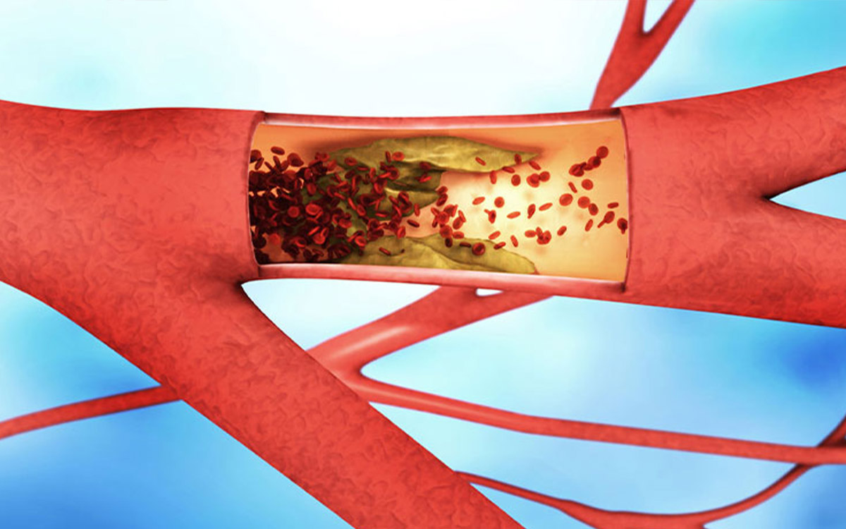 Risk Factors in Peripheral Artery Diseases