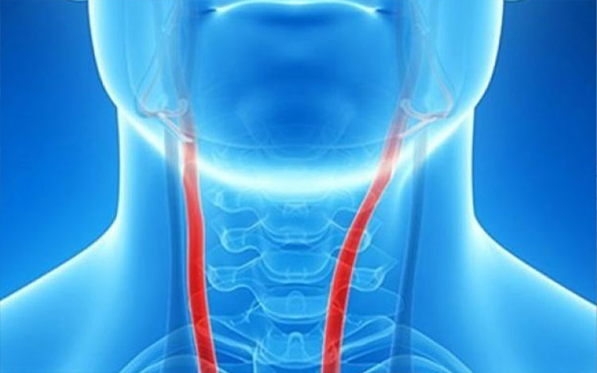 What is Carotid Artery Disease?