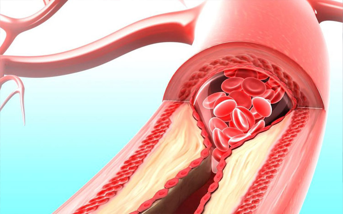 Symptoms of Carotid Artery Occlusion