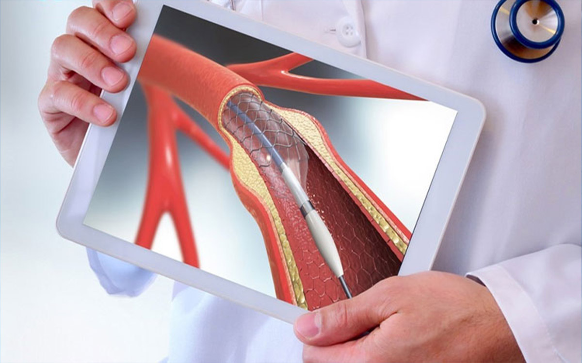 Carotid Artery Occlusion Treatment